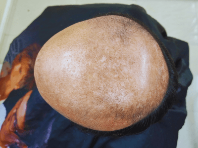 Before Hair Bonding