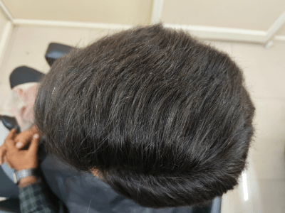 After Hair Bonding